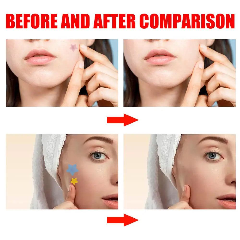 Babe's Acne Patches
